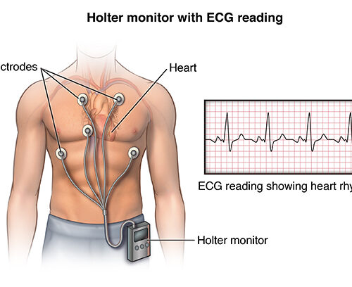 Electrocardiogram (ECG) / Holter / Event Monitor