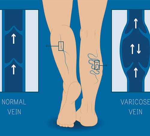 Venous Reflux Study