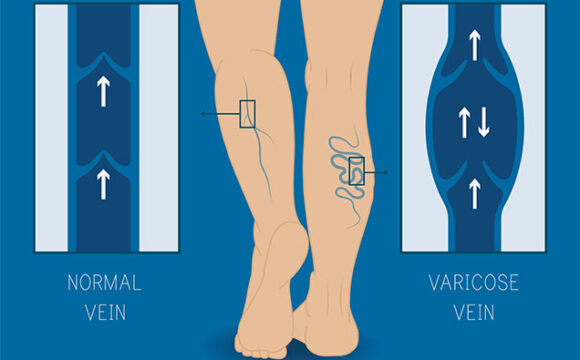 Venous Reflux Study