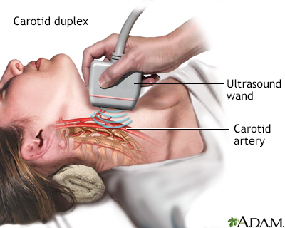 Carotid Duplex