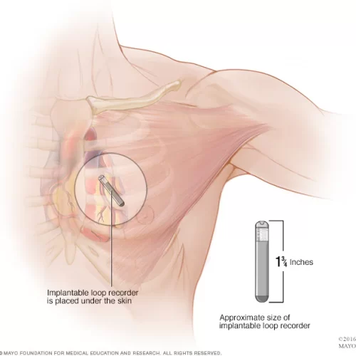 Long-term monitors (Implantable Loop Recorder)