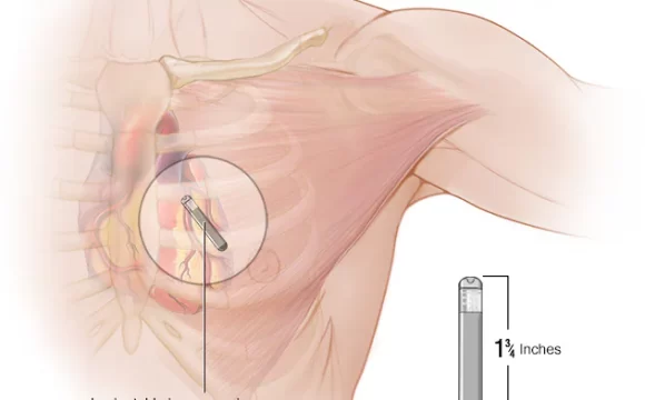 Long-term monitors (Implantable Loop Recorder)