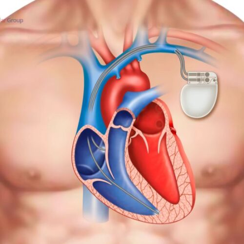 Pacemaker Interrogation.