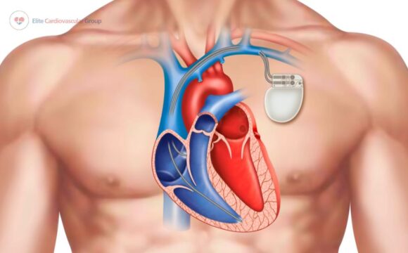 Pacemaker Interrogation.