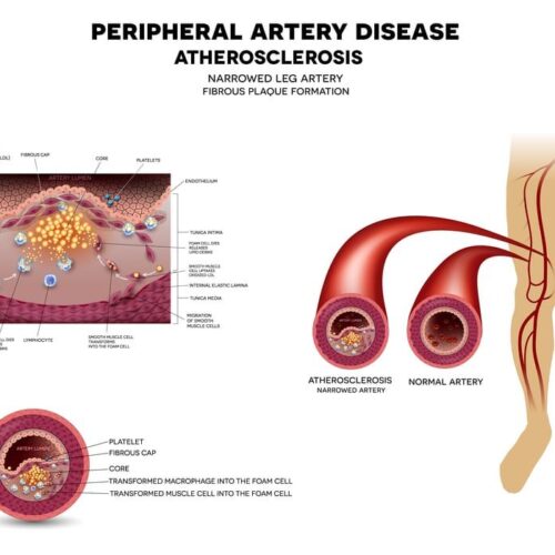 Peripheral Vascular Intervention