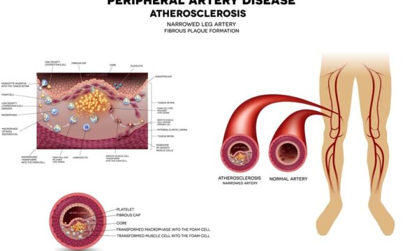 Peripheral Vascular Intervention