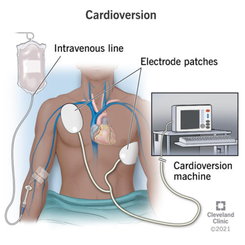 Cardioversion