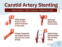 Carotid Stenting