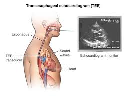 Transesophageal Echocardiogram (TEE)