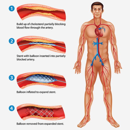 Percutaneous Coronary Intervention (PCI)