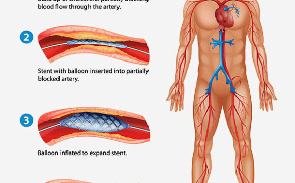 Percutaneous Coronary Intervention (PCI)