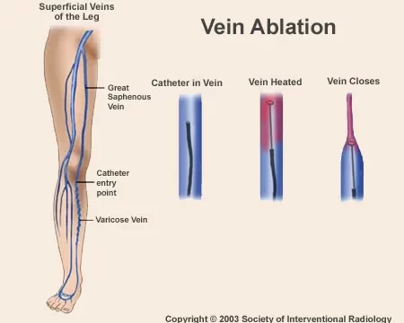 Venous Ablations