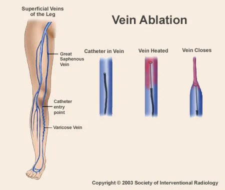 Venous Ablations